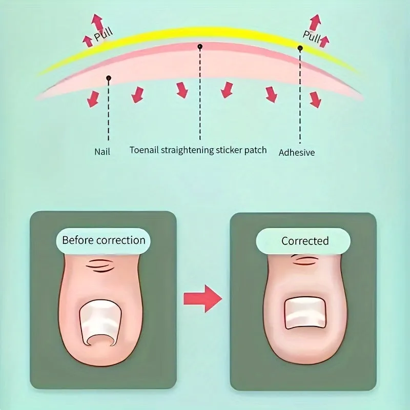 Painless Ingrown Toenail Corrector Stickers GlueFree Pedicure Solution